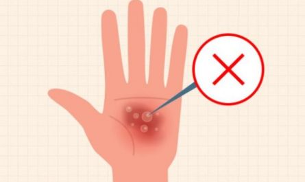 7 Spiritual Meanings of Dreaming of Blisters