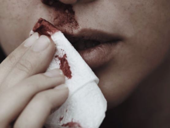 10 Interpretations of Dreaming About Nosebleeds